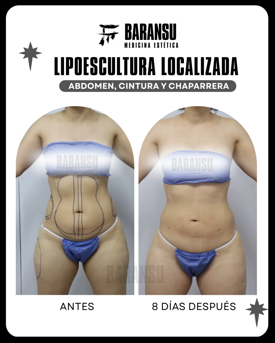 Lipoescultura Localizada (Minilipo) 6