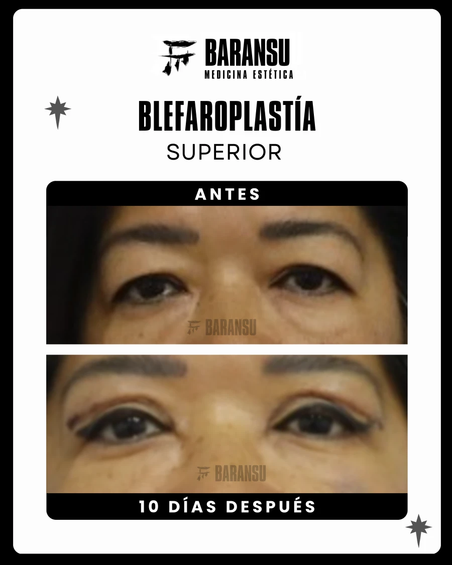 Blefaroplastía Superior