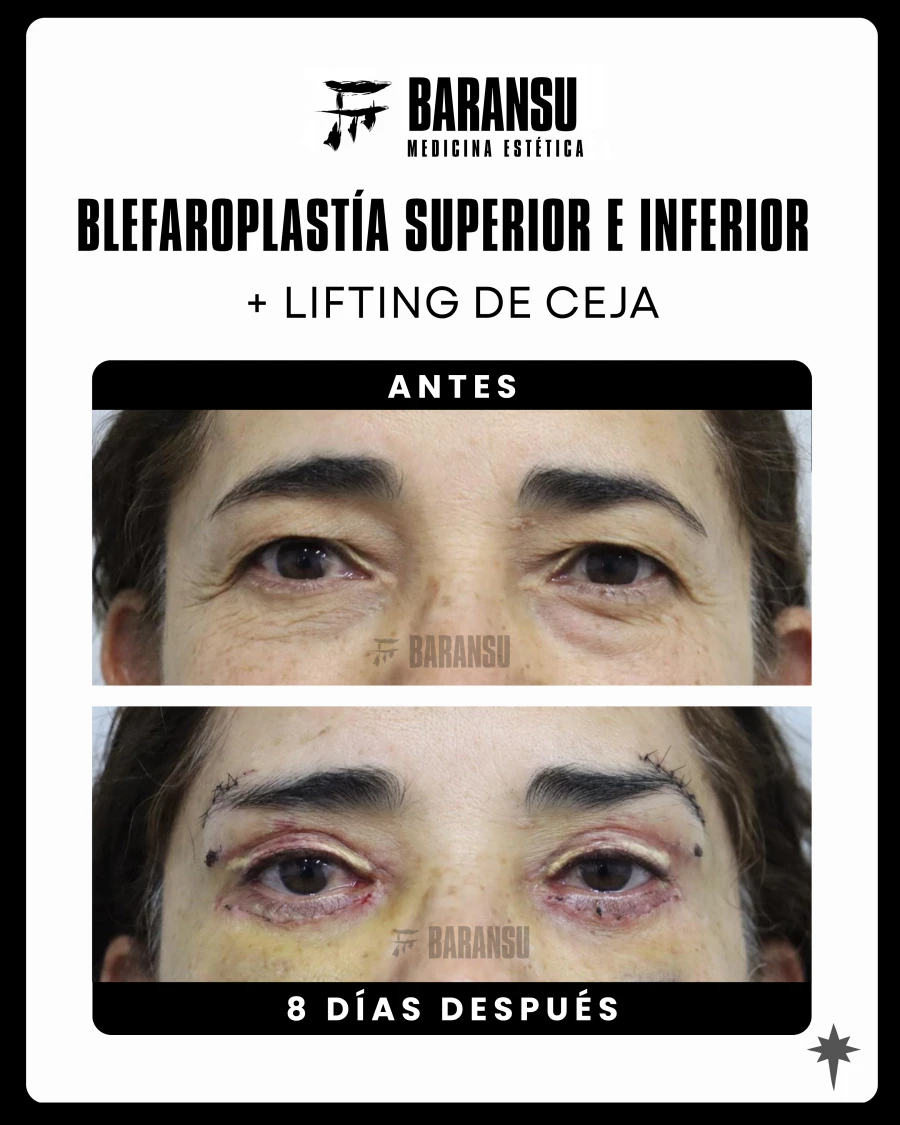 Blefaroplastía Superior e Inferior + Lifting de ceja  