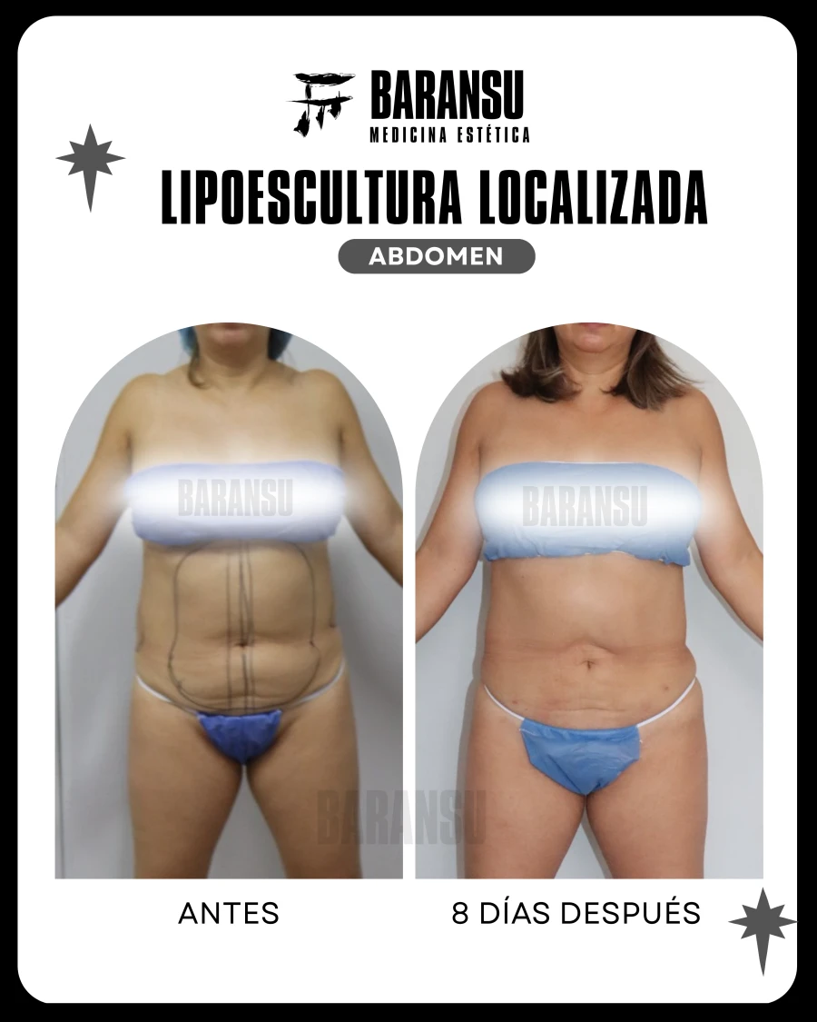 Lipoescultura Localizada (Minilipo) 3