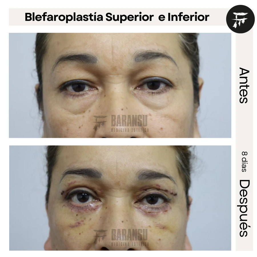 Blefaroplastía Superior e Inferior