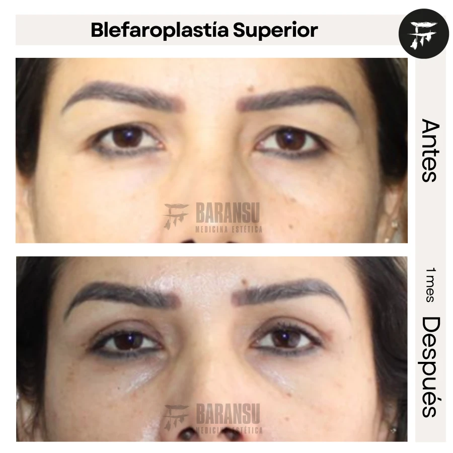Blefaroplastía Superior
