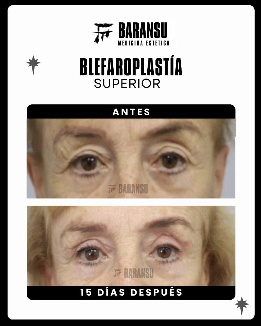 Blefaroplastía Superior 10