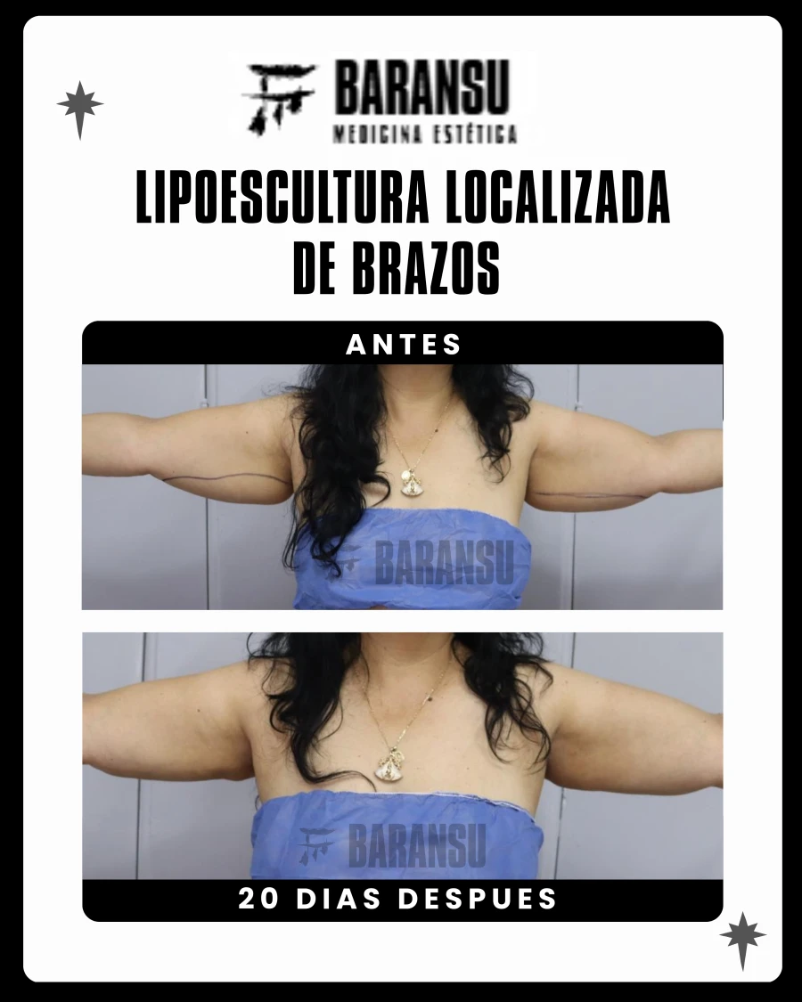 Lipoescultura Localizada de Brazos
