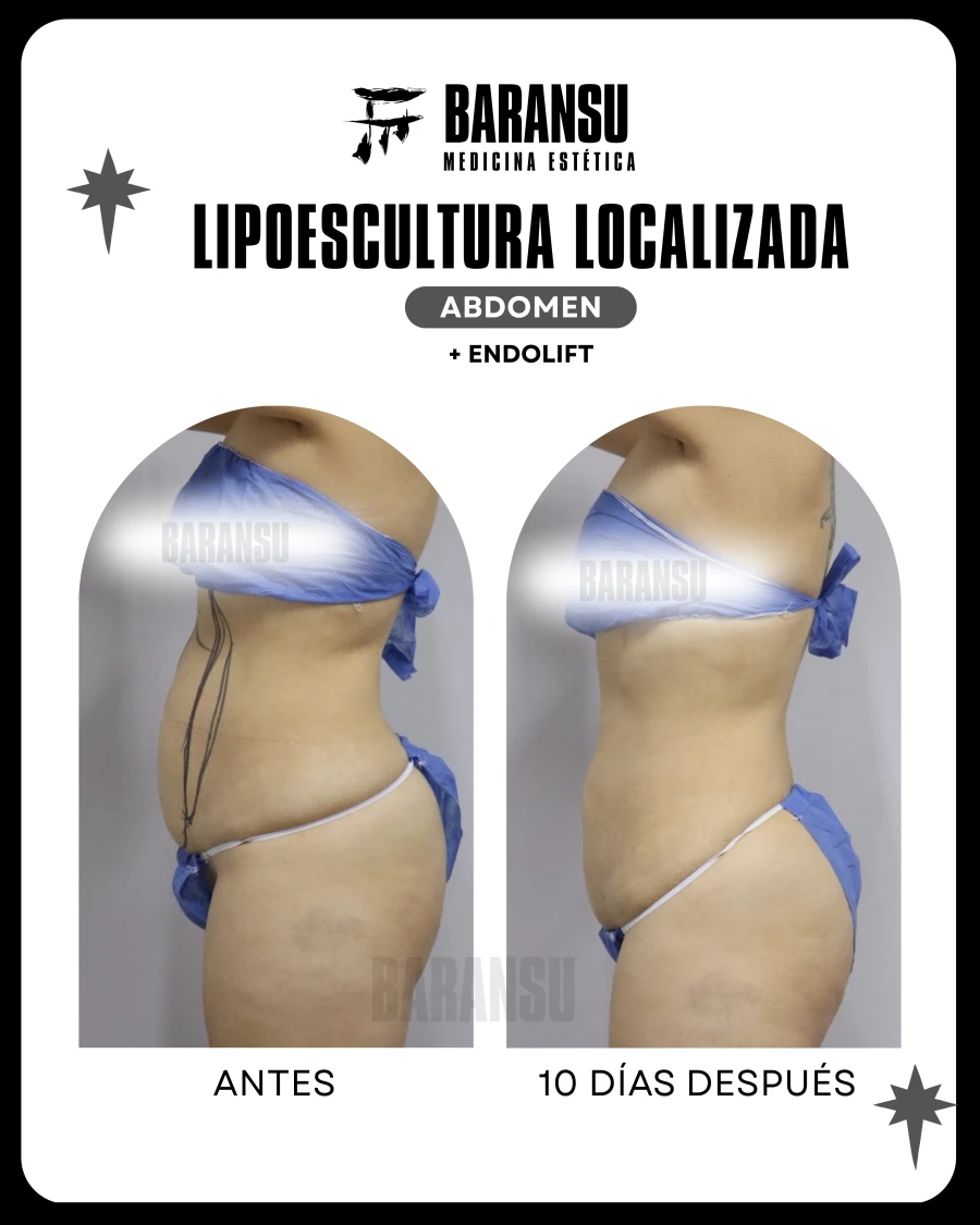 Lipoescultura Localizada (Minilipo) 27
