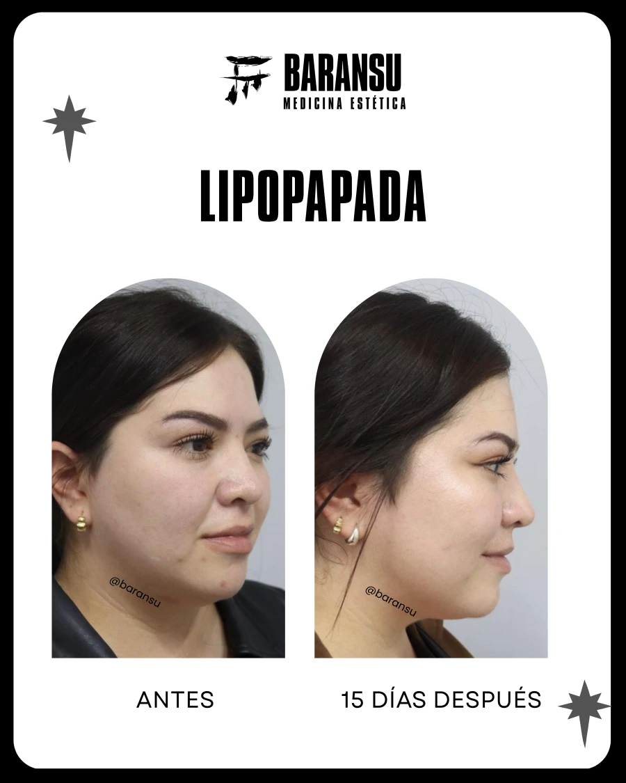 Lipo de Papada 1