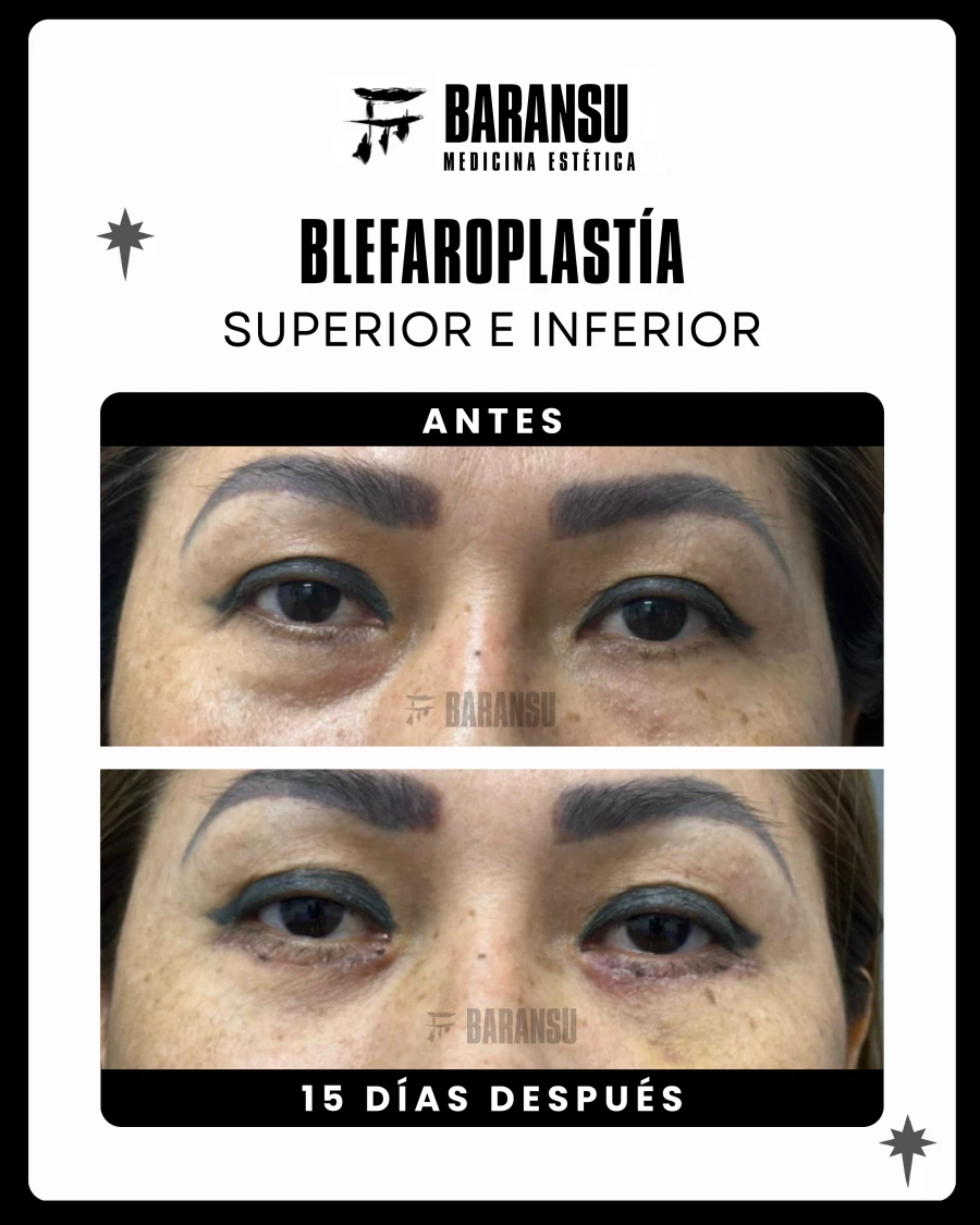 Blefaroplastía Superior e Inferior 