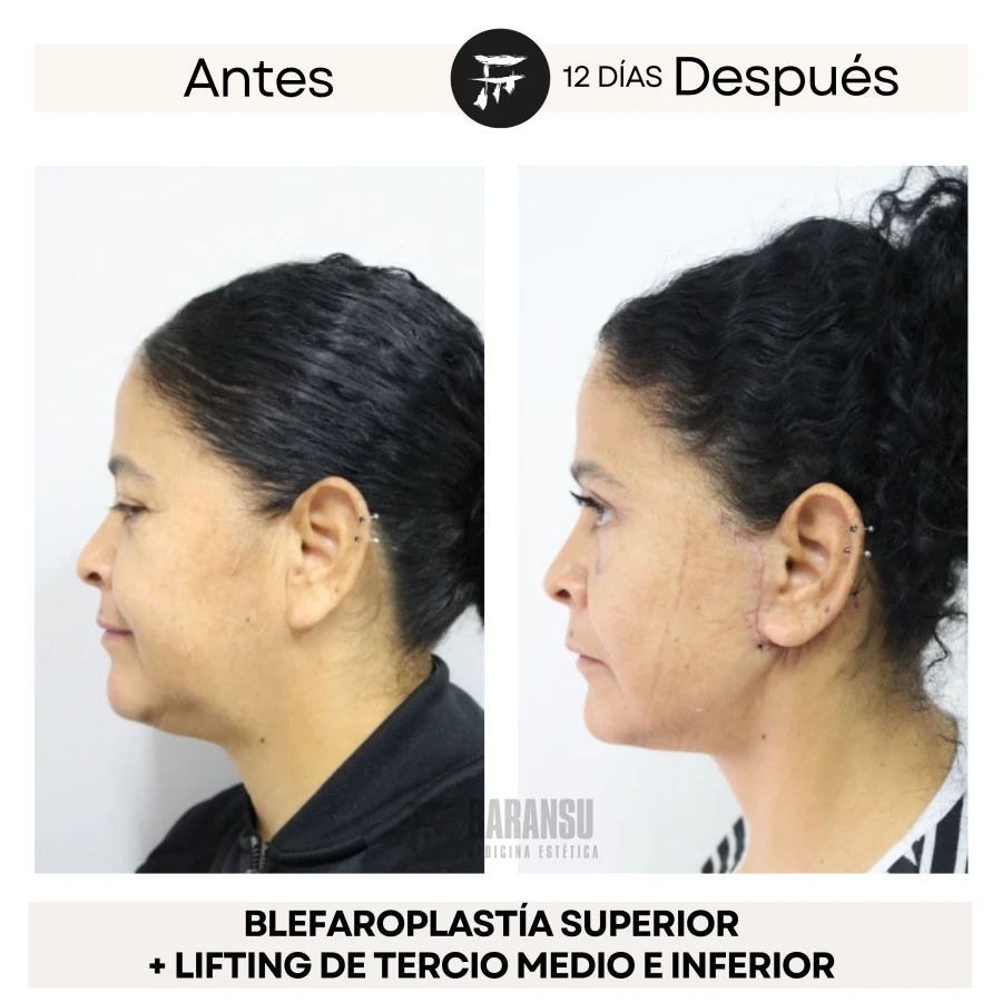 Lifting Facial Tercio Medio Inferior + Blefaroplastía Superior