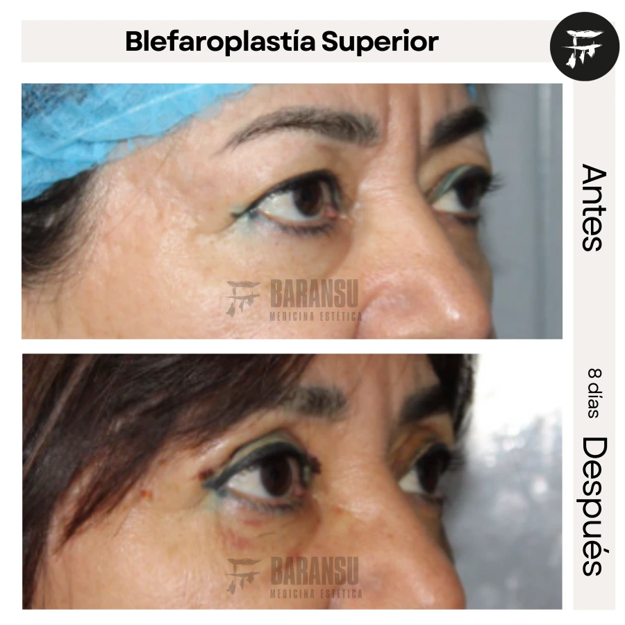 Blefaroplastía Superior