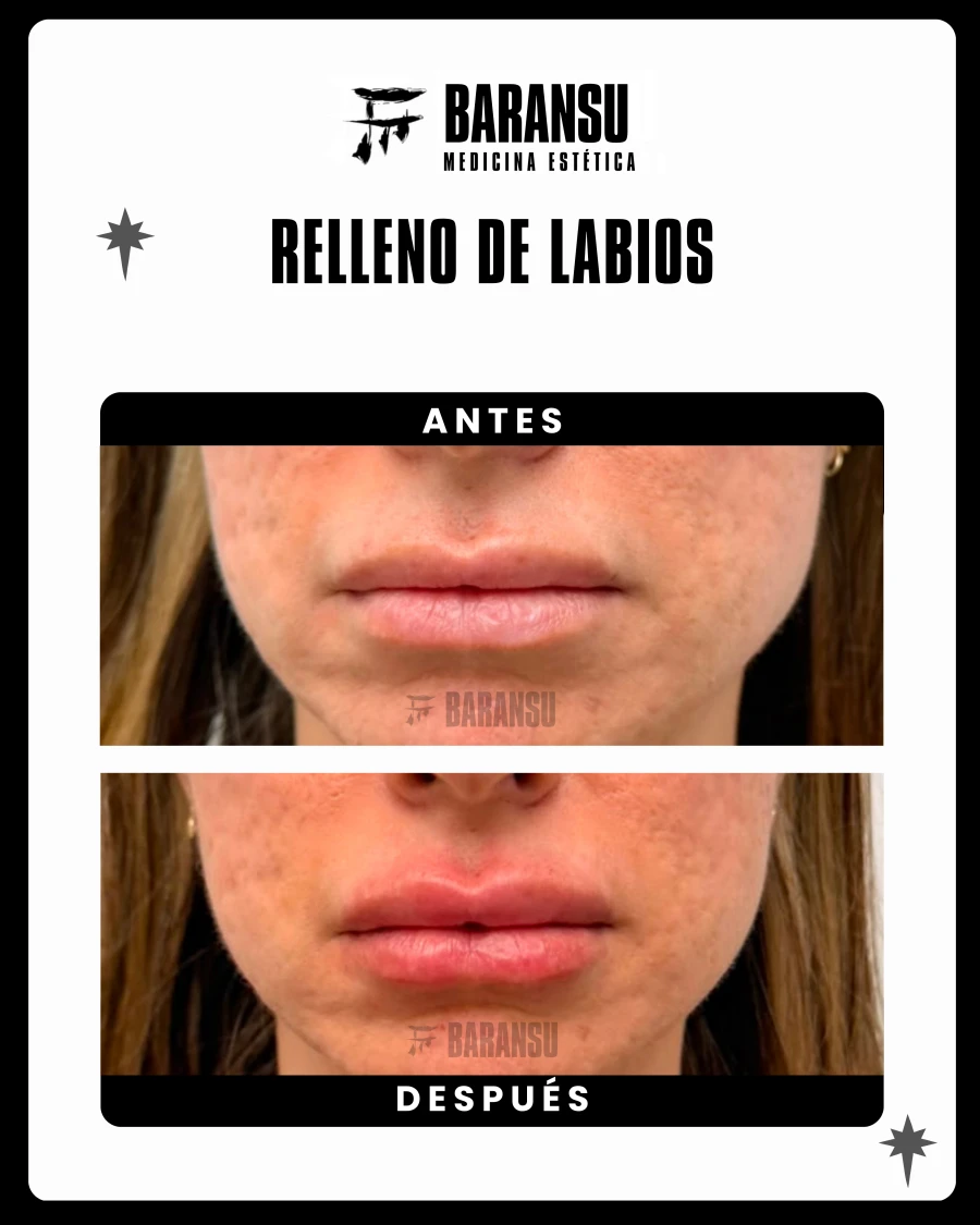 Relleno de Labios 7