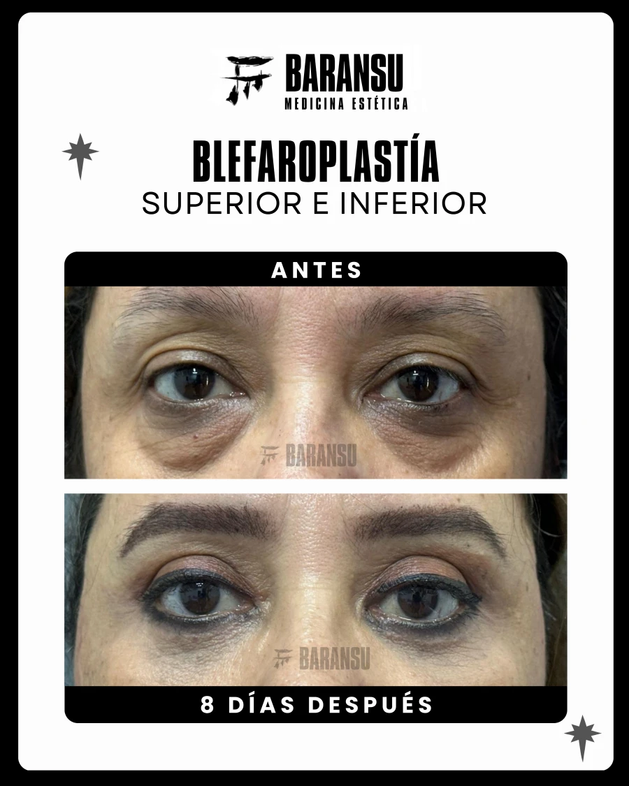 Blefaroplastía Superior e Inferior