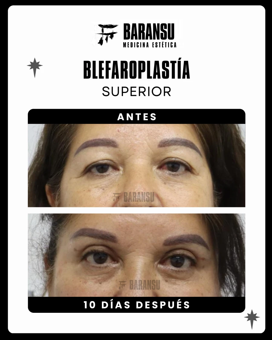 Blefaroplastía Superior