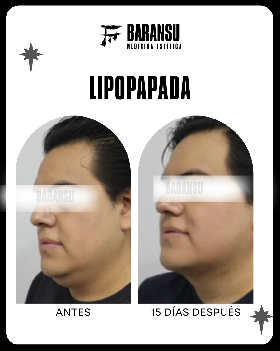 Lipo de Papada 16