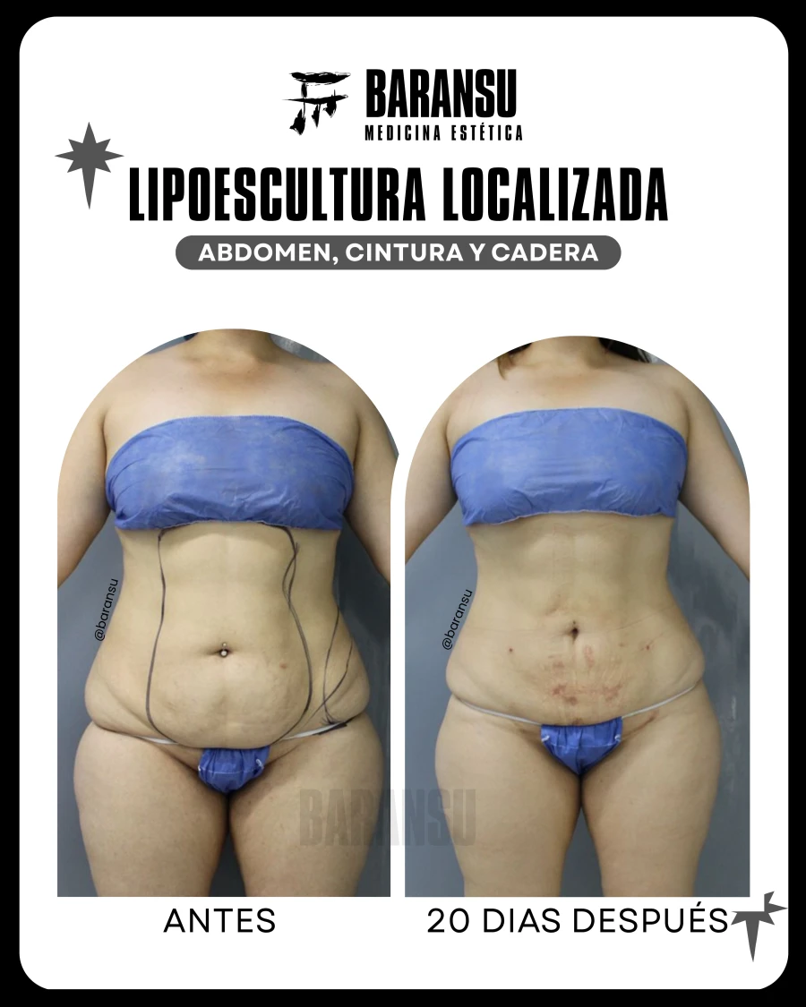 Lipoescultura Localizada (Minilipo) 44