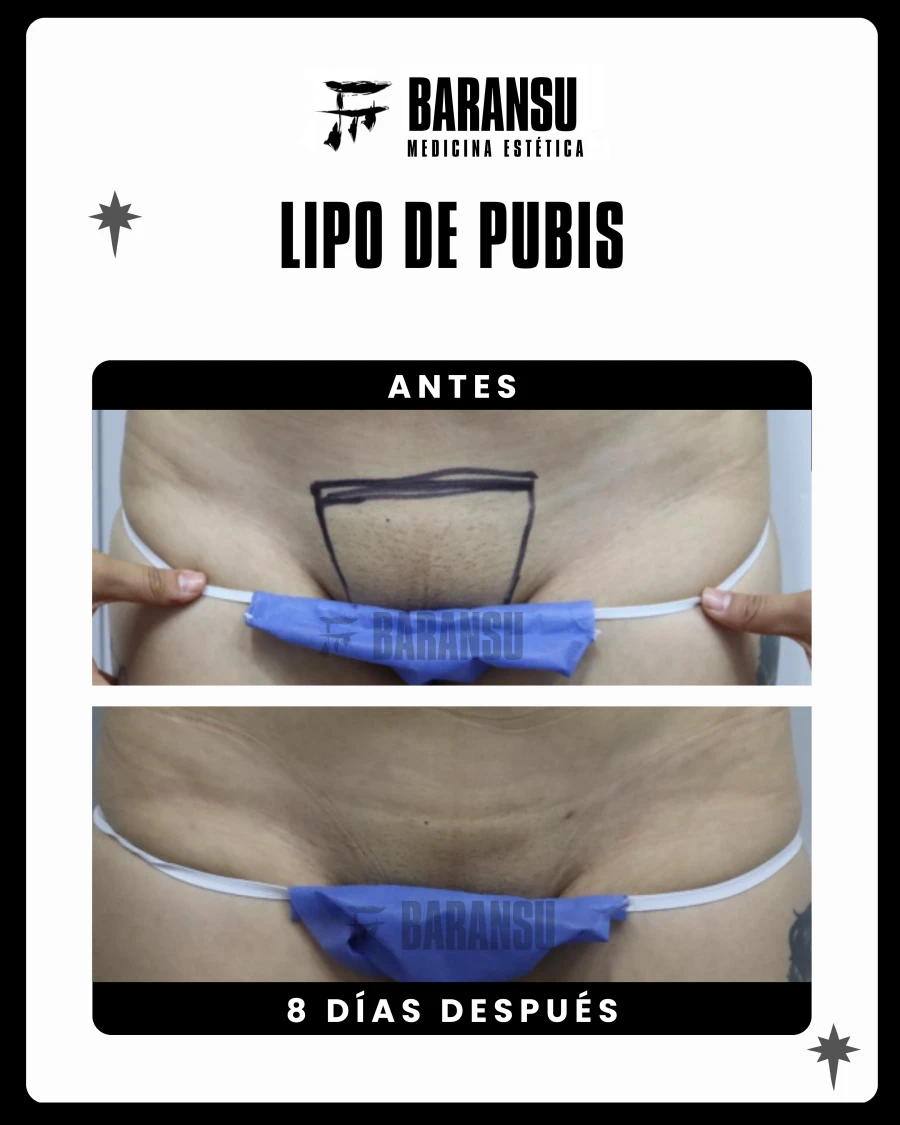Lipo de Pubis