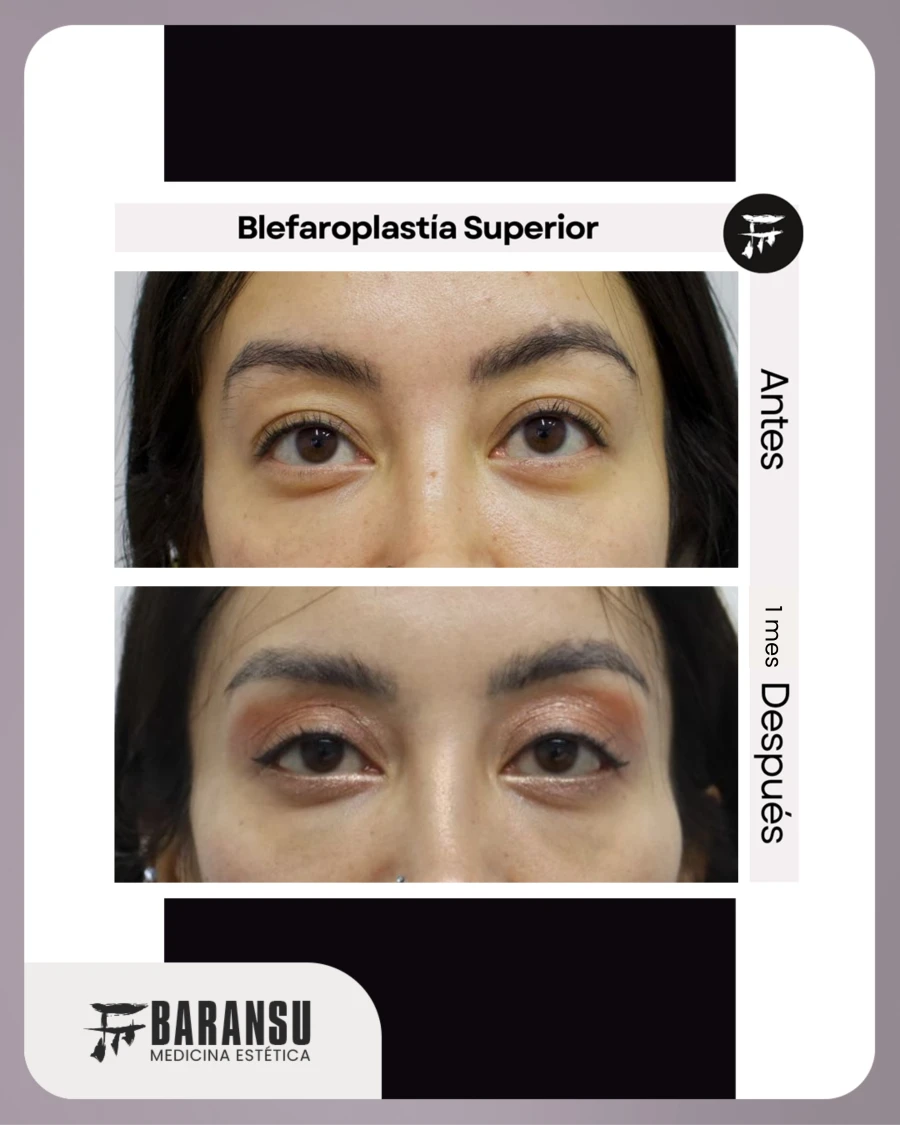 Blefaroplastía Superior