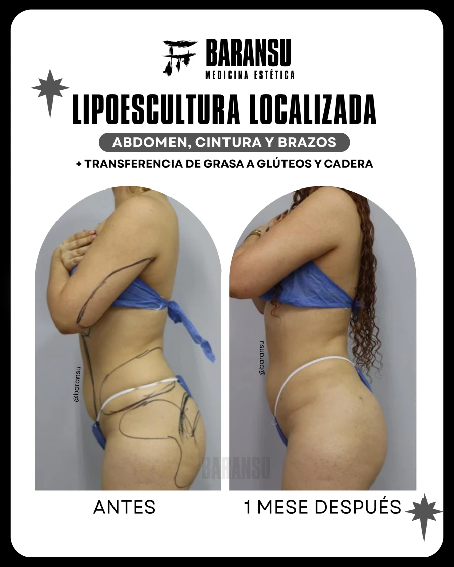 Lipoescultura Localizada (Minilipo) 43