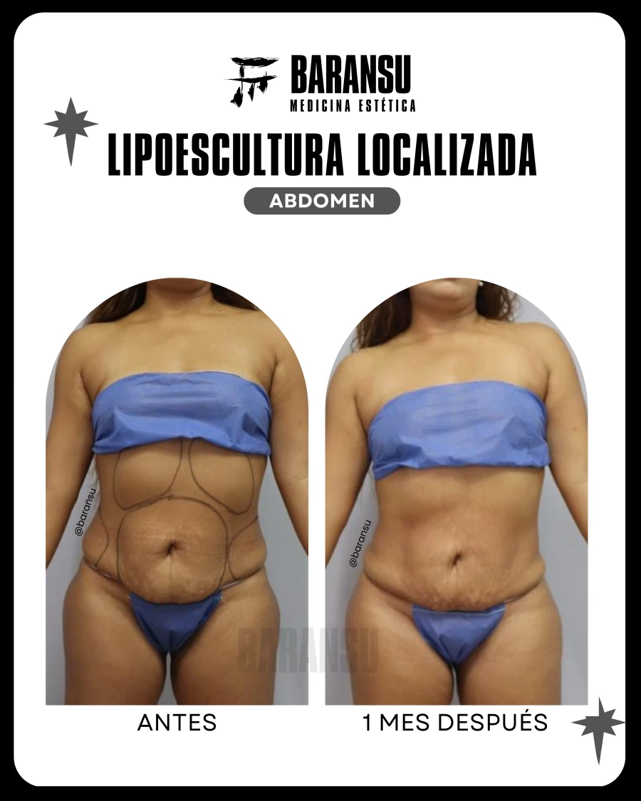 Lipoescultura Localizada (Minilipo) 39