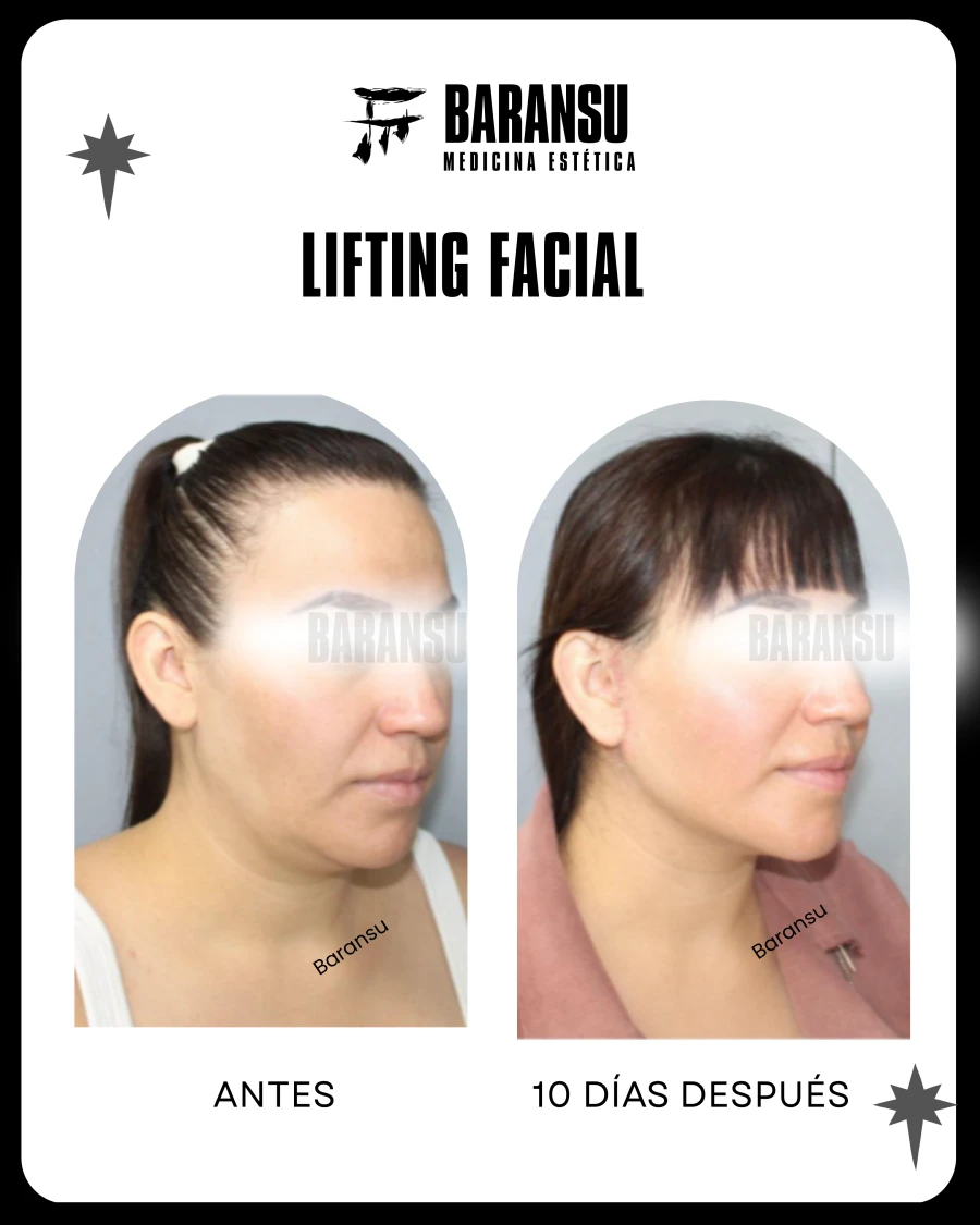 Lifting Facial 1
