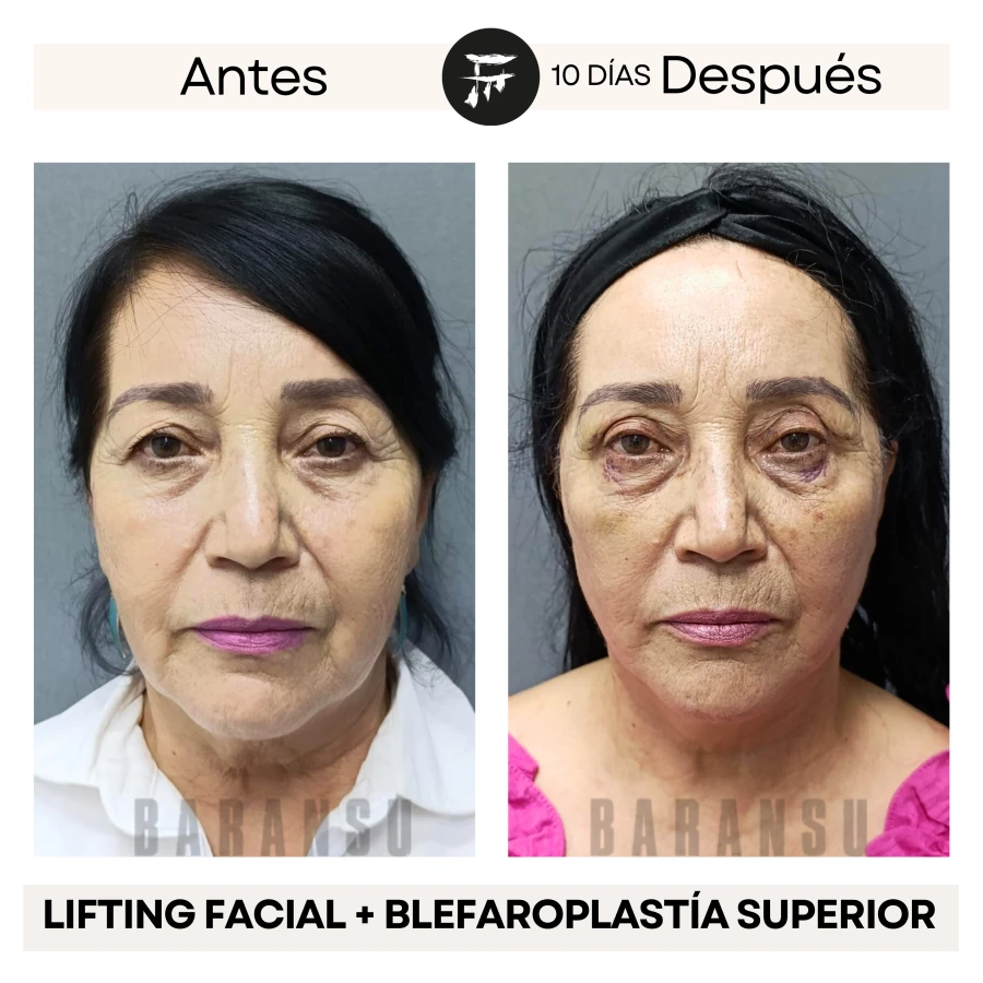 Lifting Facial + Blefaroplastía Superior
