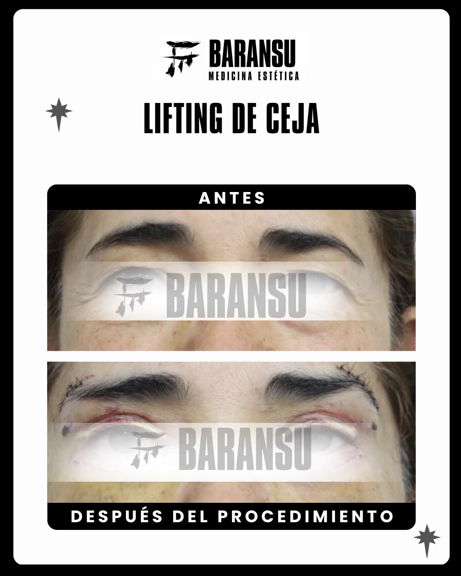 Lifting de ceja 