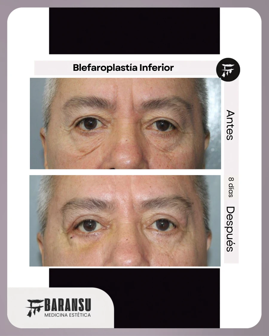 Blefaroplastía Inferior