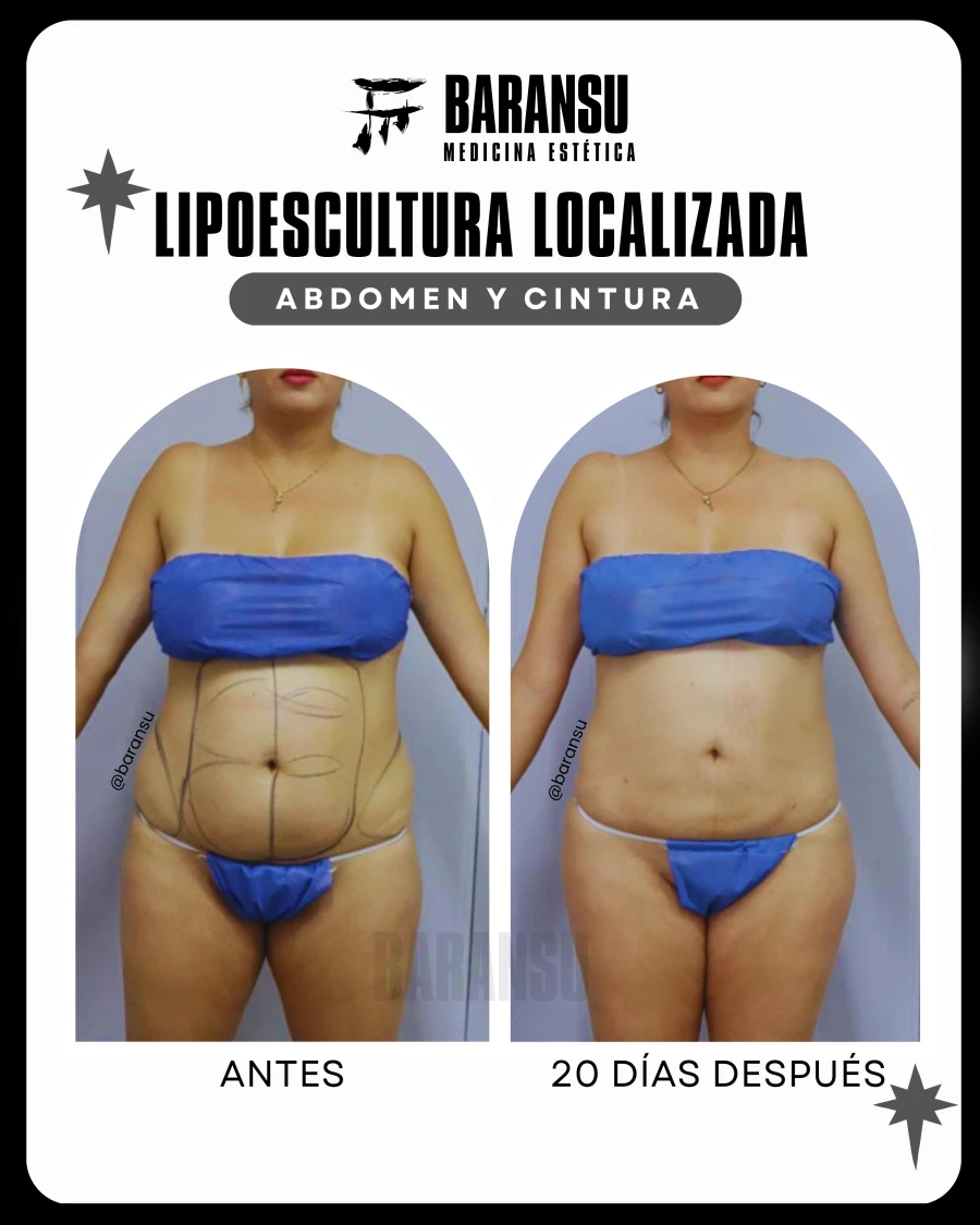 Lipoescultura Localizada (Minilipo) 14