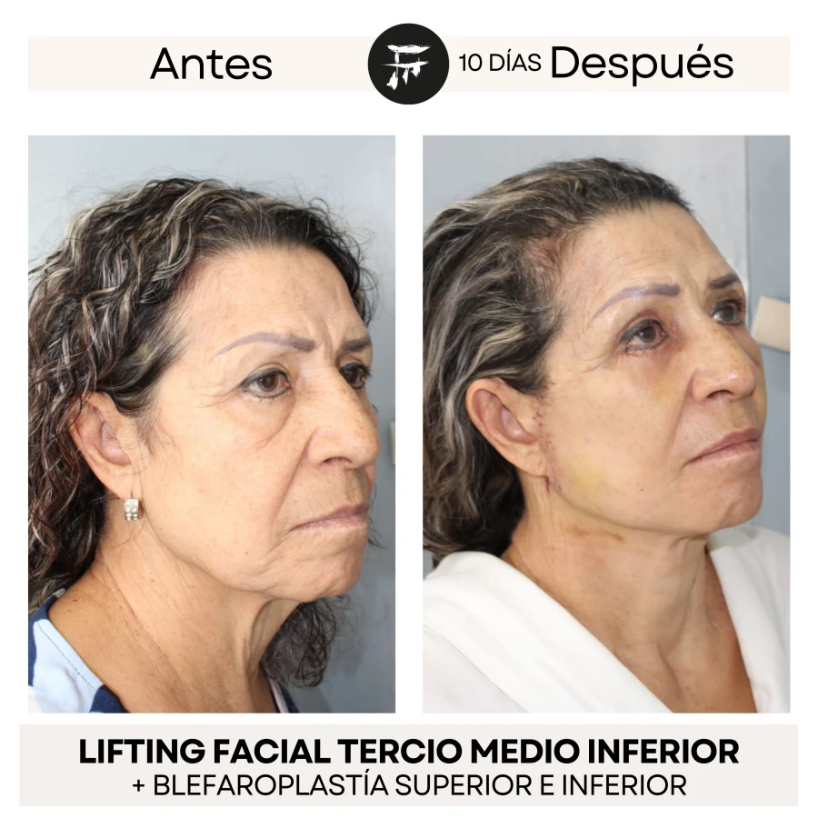Lifting Facial + Blefaroplastía Superior e Inferior