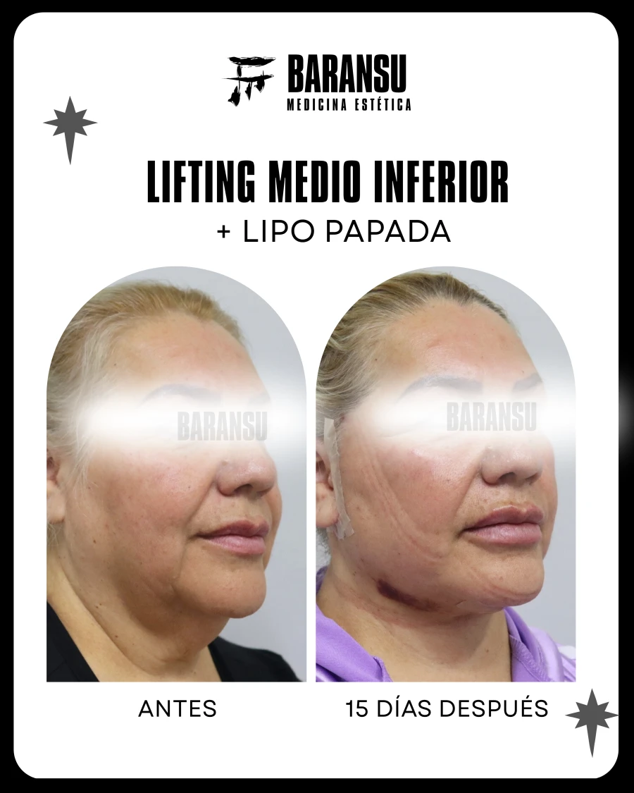 Lifting Medio Inferior Facial + Lipo Papada 8