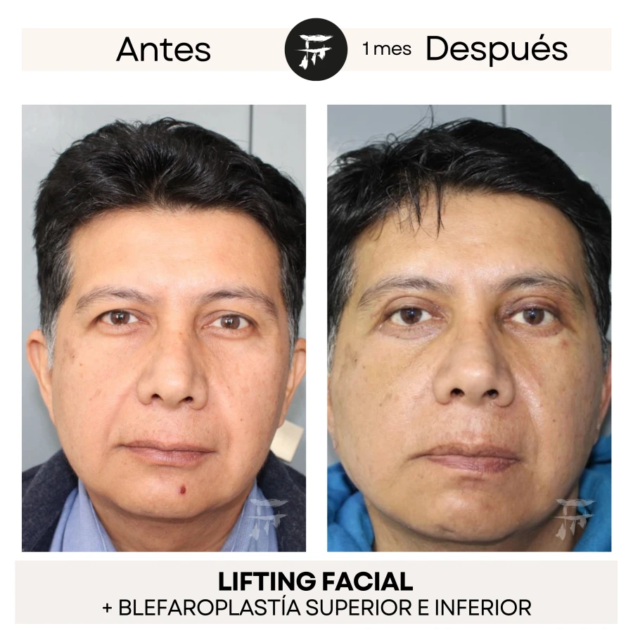 Lifting Facial + Blefaroplastía Superior e Inferior