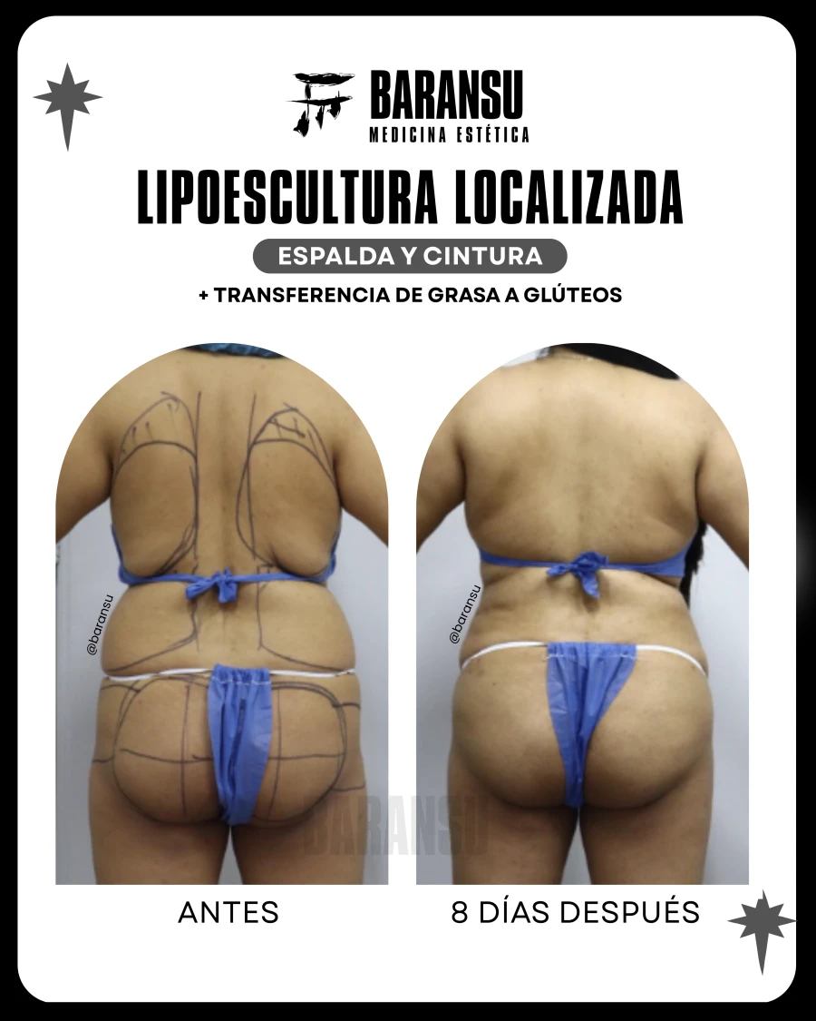 Lipoescultura Localizada (Minilipo) 2