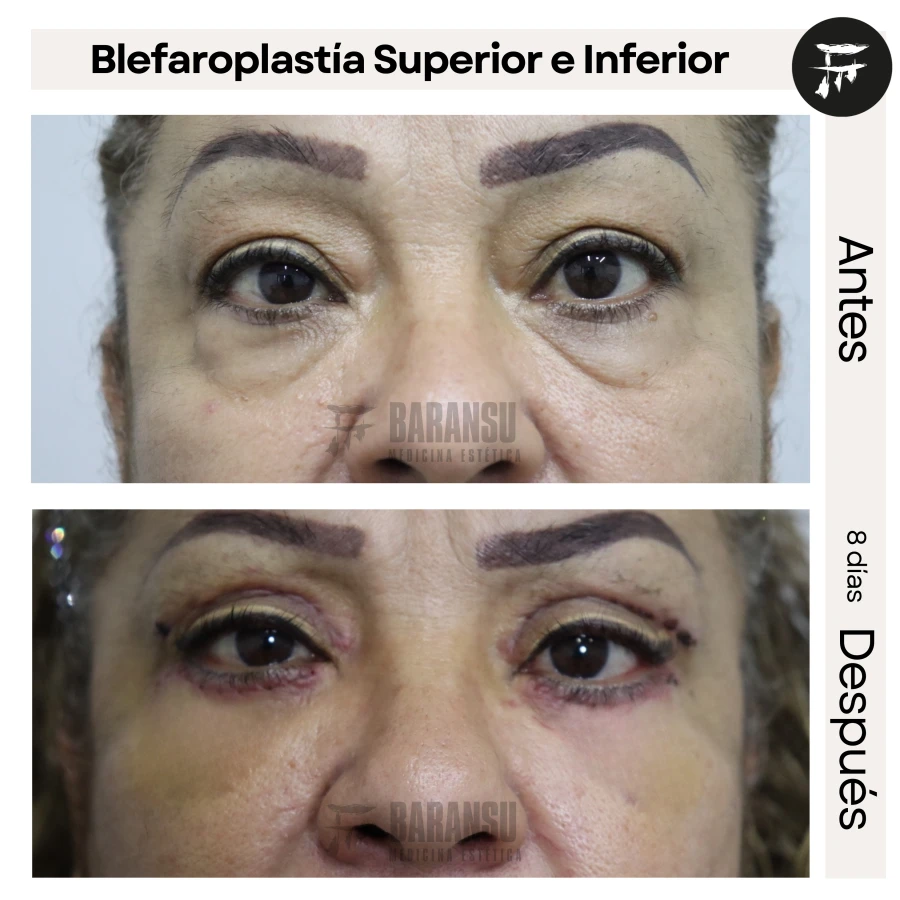 Blefaroplastía Superior e Inferior