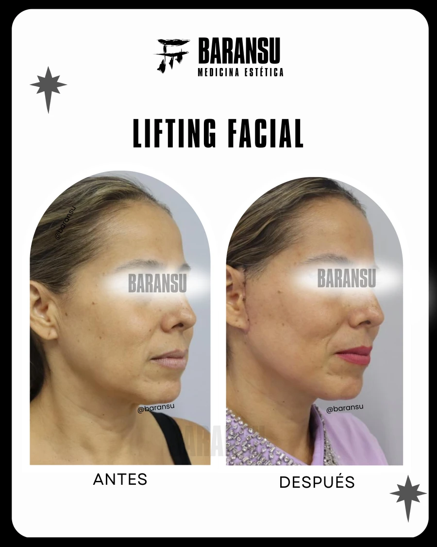 Lifting Facial 21