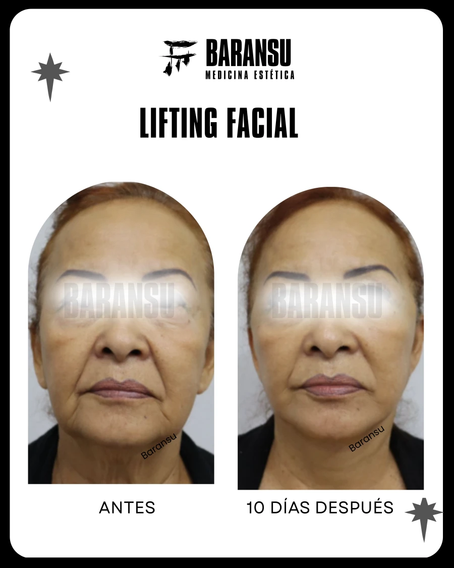 Lifting Facial 3