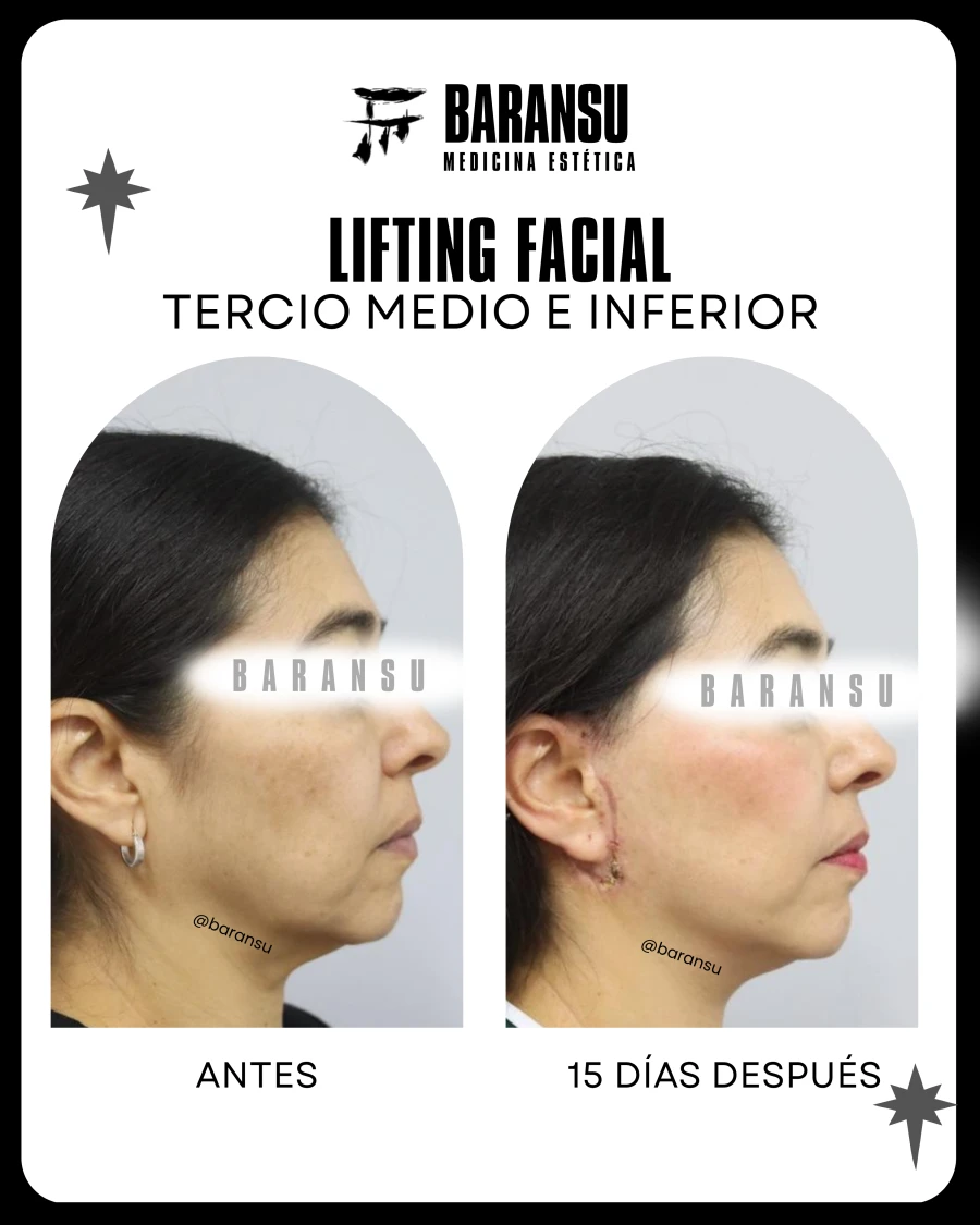 Lifting Facial Tercio Medio Inferior 7