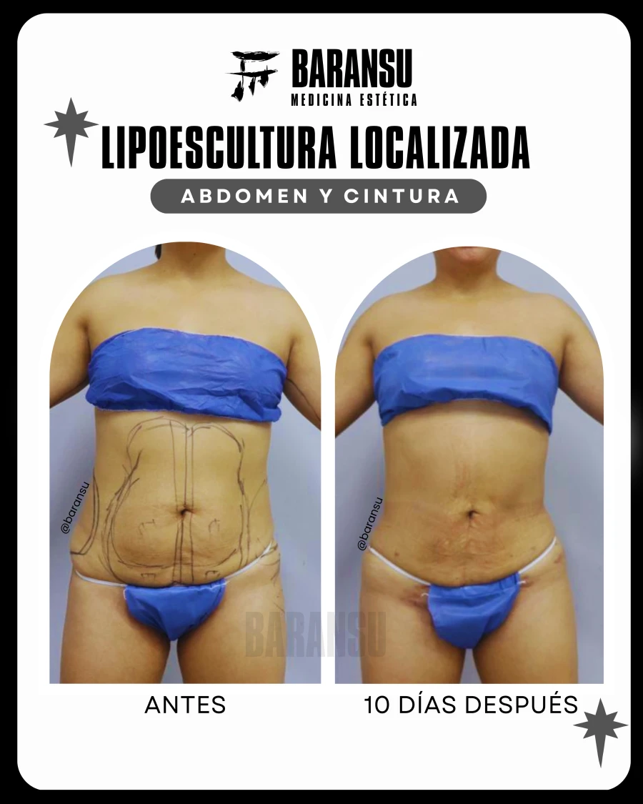 Lipoescultura Localizada (Minilipo) 15