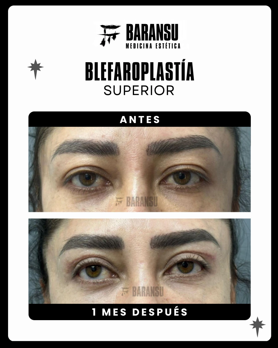 Blefaroplastía Superior