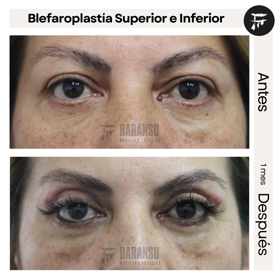 Blefaroplastía Superior