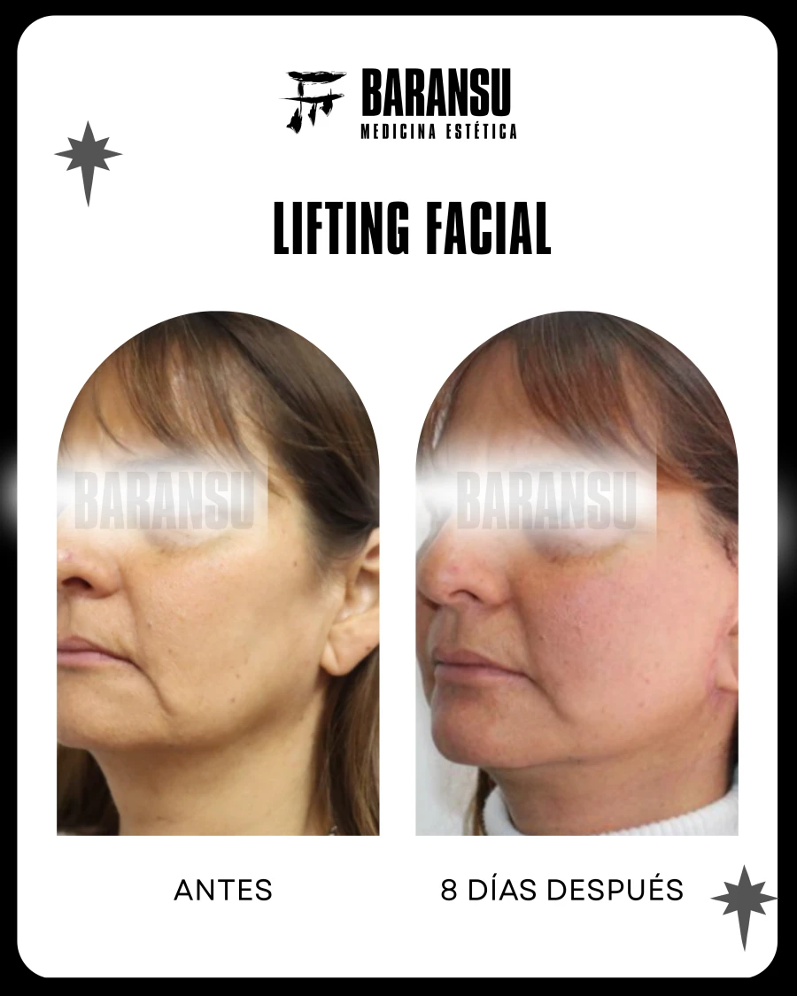 Lifting Facial 18