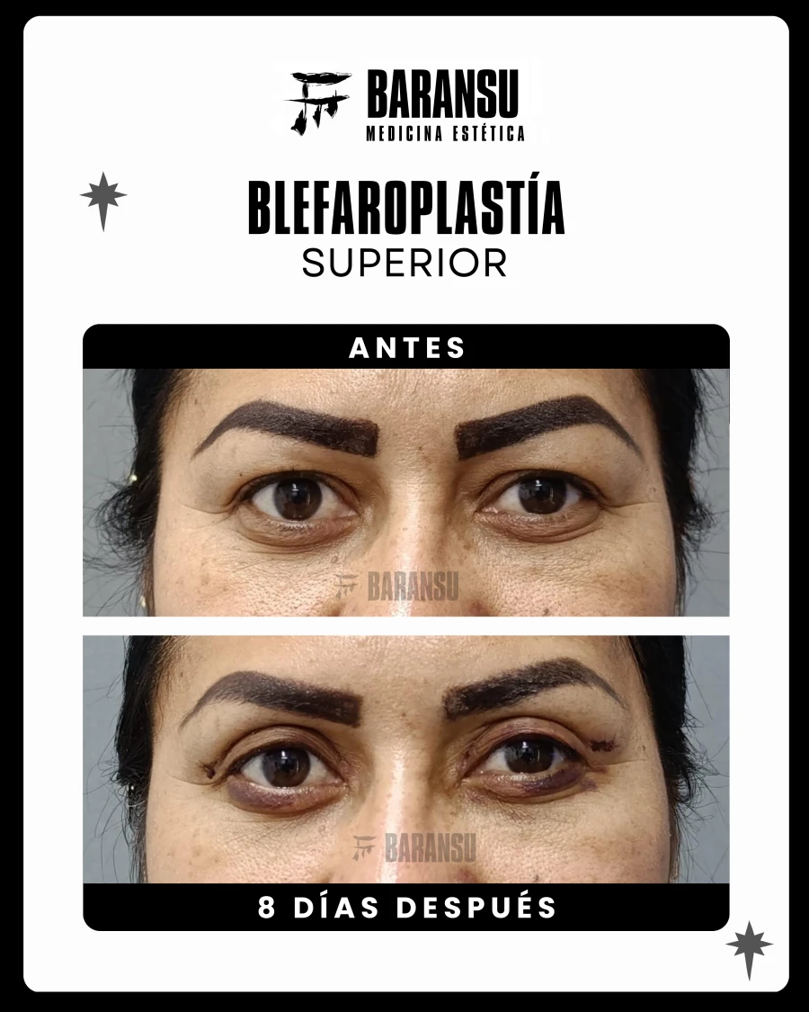 Blefaroplastía Superior