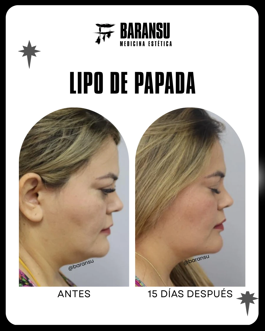 Lipo de Papada 10