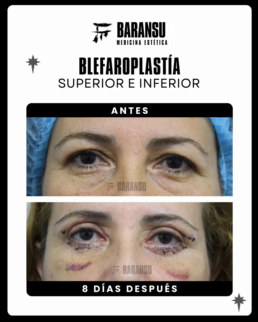 Blefaroplastía Superior e Inferior 