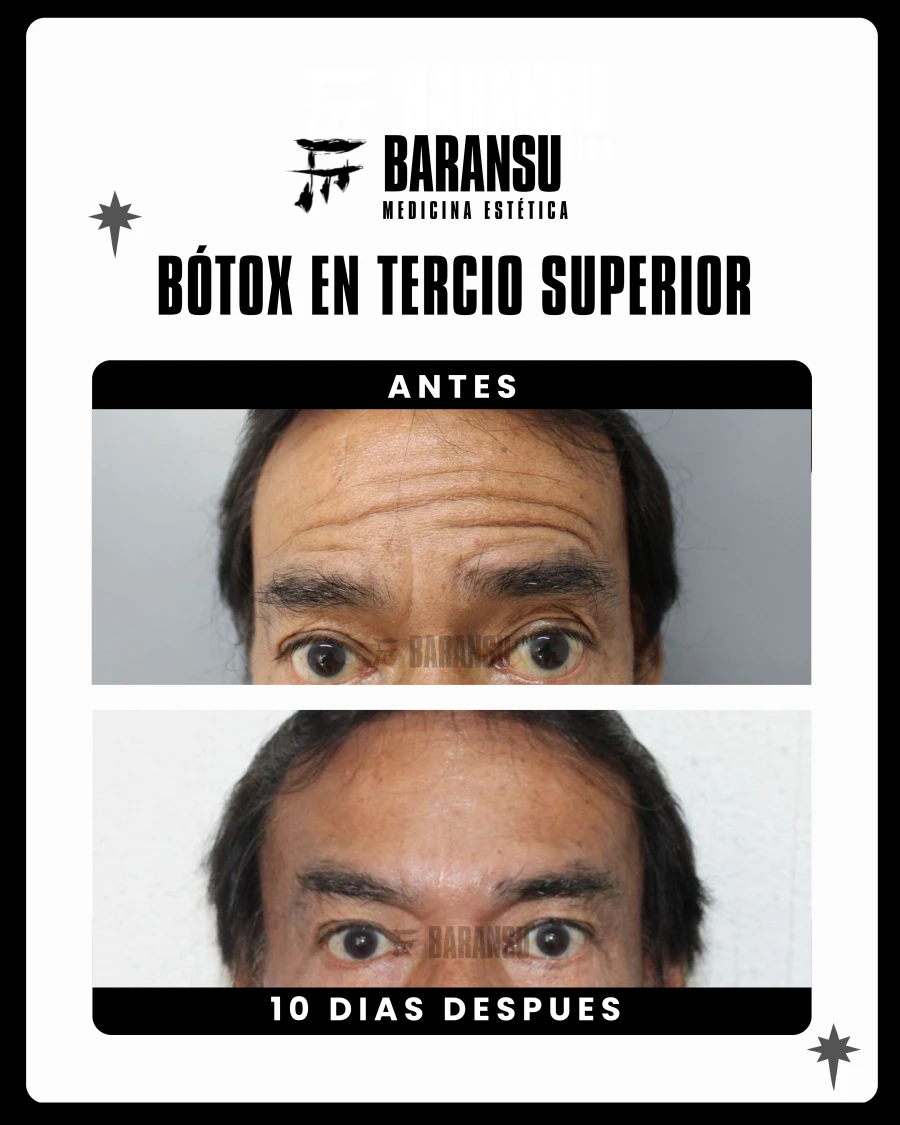Bótox