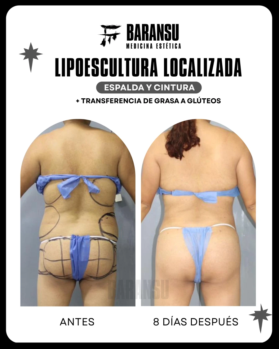 Lipoescultura Localizada (Minilipo) 31