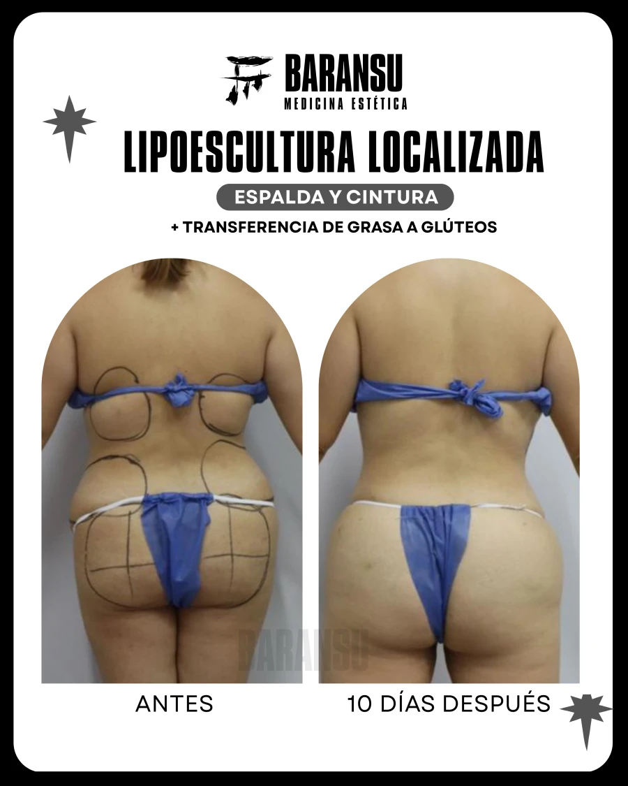 Lipoescultura Localizada (Minilipo) 28