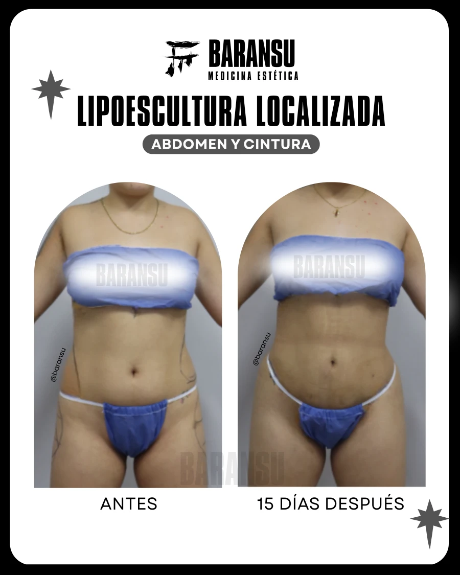 Lipoescultura Localizada (Minilipo) 33