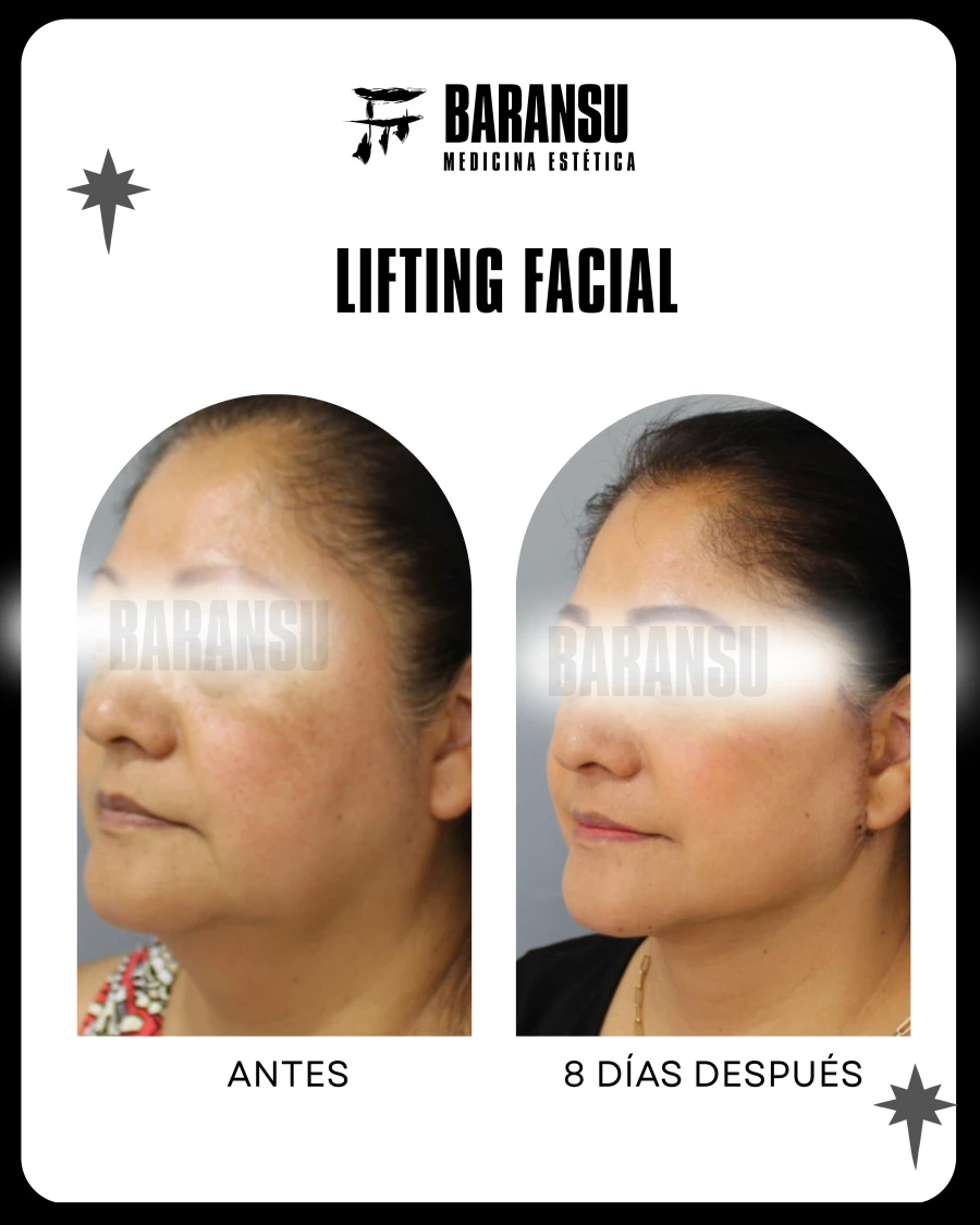 Lifting Facial 5