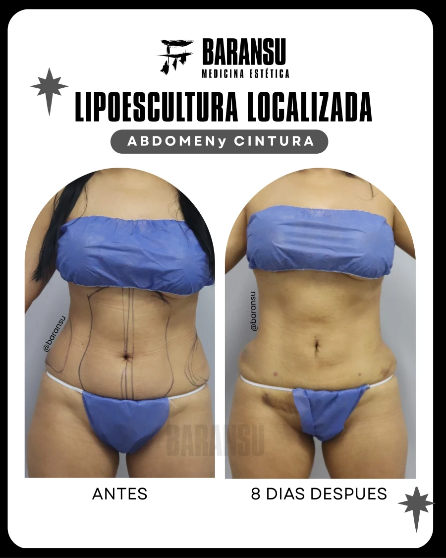 Lipoescultura Localizada (Minilipo) 50