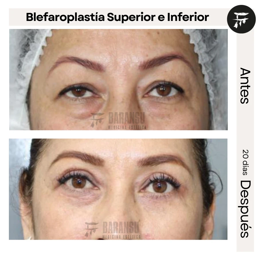 Blefaroplastía Superior e Inferior