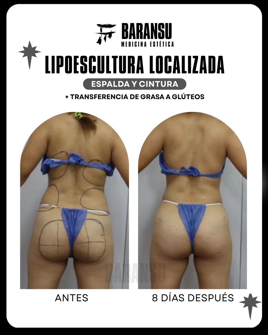 Lipoescultura Localizada (Minilipo) 22